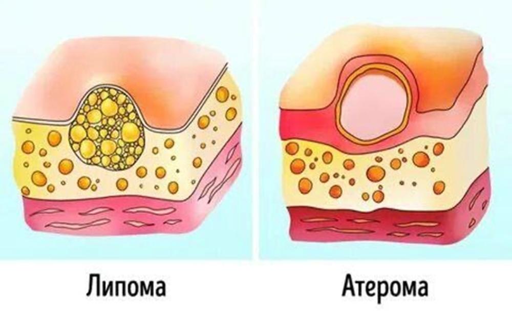 Как избавиться от липомы на спине