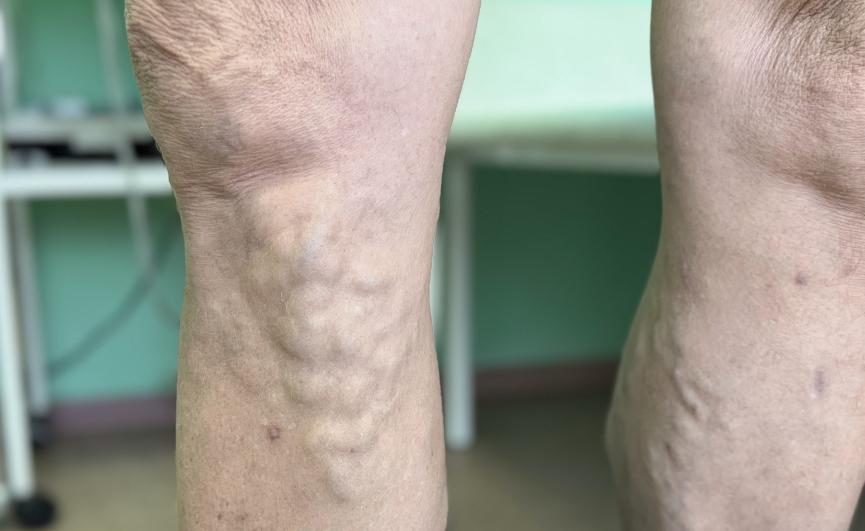 Что такое варикоз с точки зрения хирурга