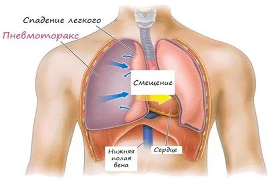 Что такое пневмоторакс легкого?