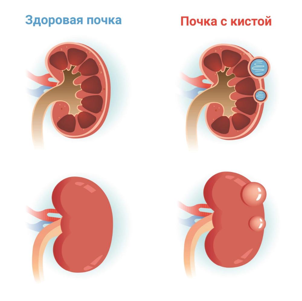 Что такое кисты почек?